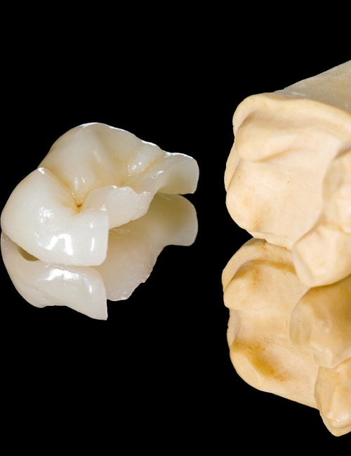 Metal free dental crown and tooth model