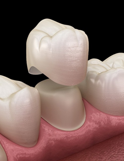 3D illustration of a dental crown    
