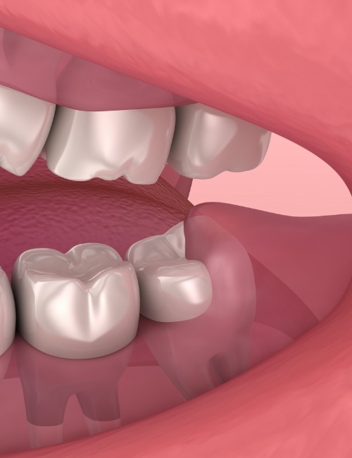 Animated smile with impacted wisdom tooth before removal