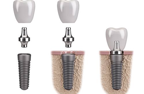Animated parts of the dental implant replacement tooth