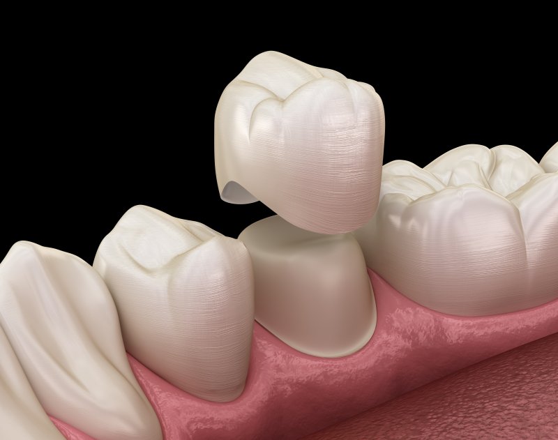 3-D diagram of a dental crown